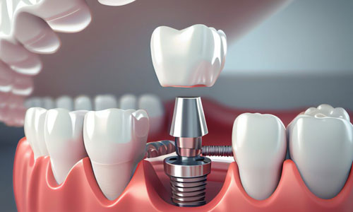 dental implant in nagpur