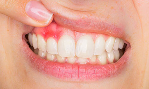 gums treatment