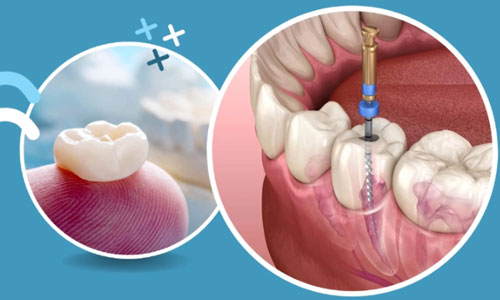 root canal treatment in nag